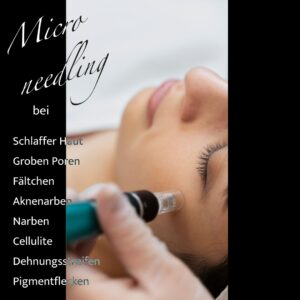 Microneedling bei schlaffer Haut, Grobporigkeit, Fältchen, Aknenarben, Narben, Cellulite, Dehnungsstreifen, Pigmentflecken